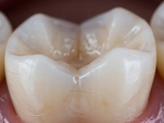 Praskliny na zubech: Mýty a fakta o trhlinách v zubech