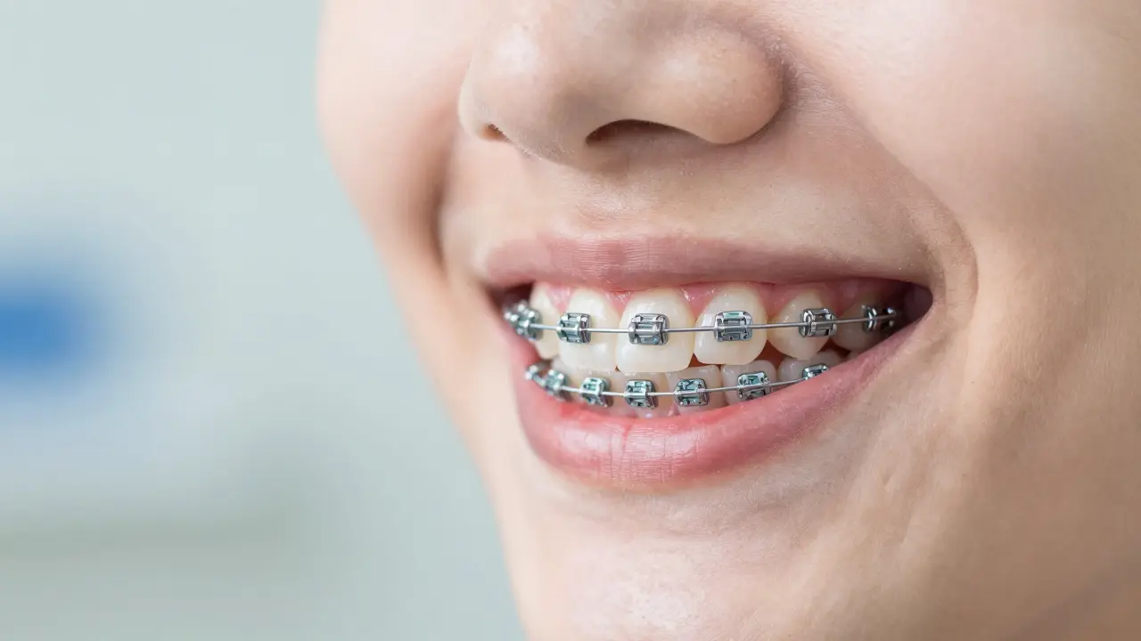 Detail úsměvu s čistými fixními rovnátkama a zdravými dásněmi.