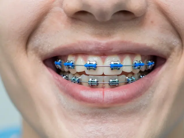 Jak dlouho bolí zuby po utažení rovnátek? Úplný průvodce úlevou